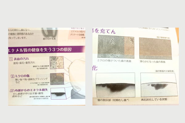 むし歯エナメル質