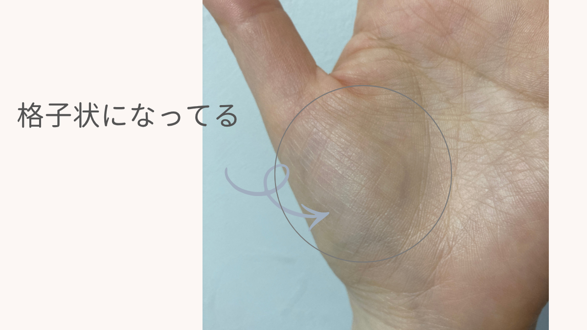 私の手のひらのセルフチェック（格子状のシワ）