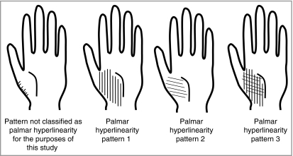 palmar hyperlinearityの3パターン